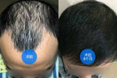 头发种植作品