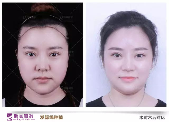 发际线种植作品